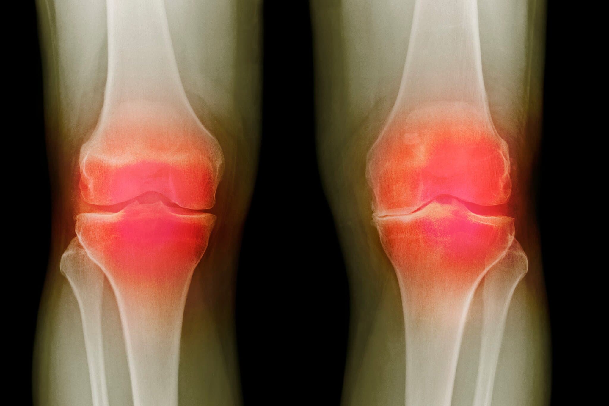 Federal Agency Unveils Three Potential Osteoarthritis Treatments