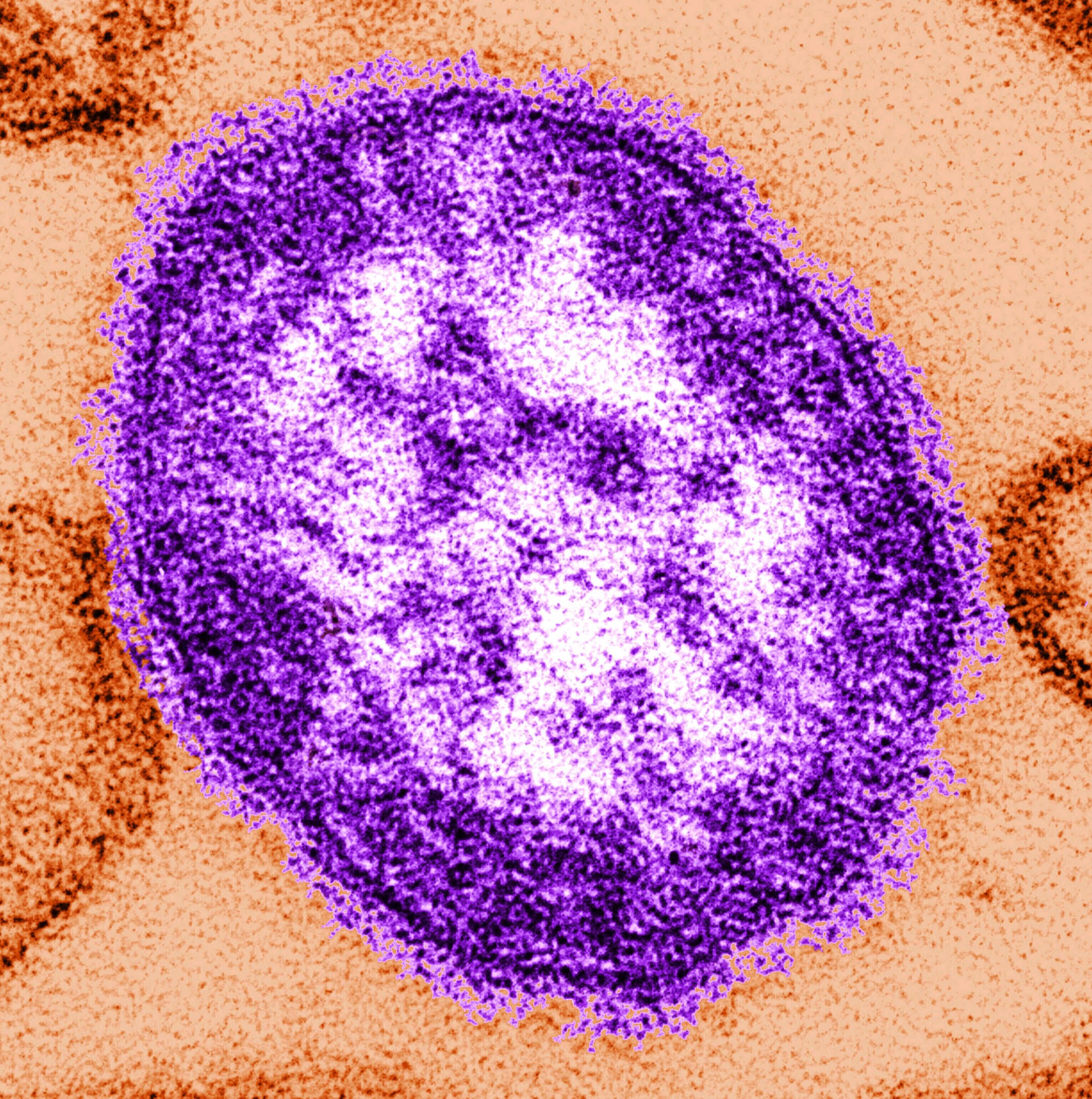 Six-Week-Old Infant Died From Measles, Lancaster Coroner Says